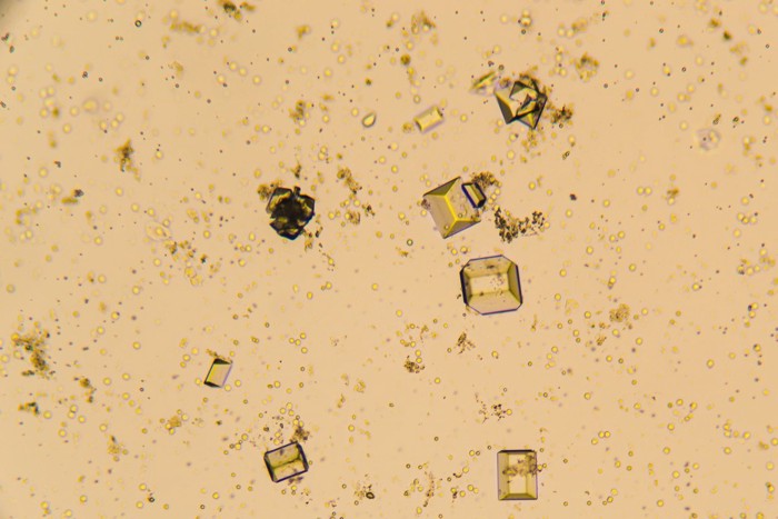 尿路結石の顕微鏡写真